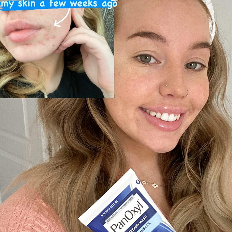 ⁦PanOxyl Creamy Wash Benzoyl Peroxide 4% Daily Control – بانوكسيل غسول كريمي يومي بحمض البنزويل ٤٪ للتحكم في حب الشباب⁩ - الصورة ⁦2⁩